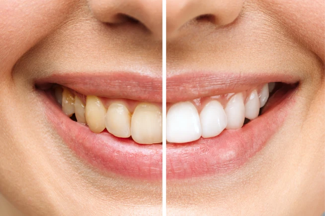 Clareamento dental em Itajubá